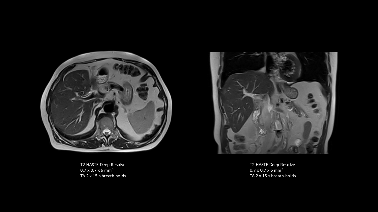 T2 HASTE for motion-robust abdominal imaging