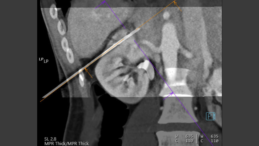 The image shows a fused coronal reconstruction, combining a contrast-enhanced CT scan fused with a coronal reconstruction of the current CT scan acquired during needle placement.