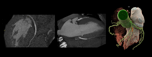 Cardiac CT Imaging of Irregular Heart Rhythms – Case Discussion with ...