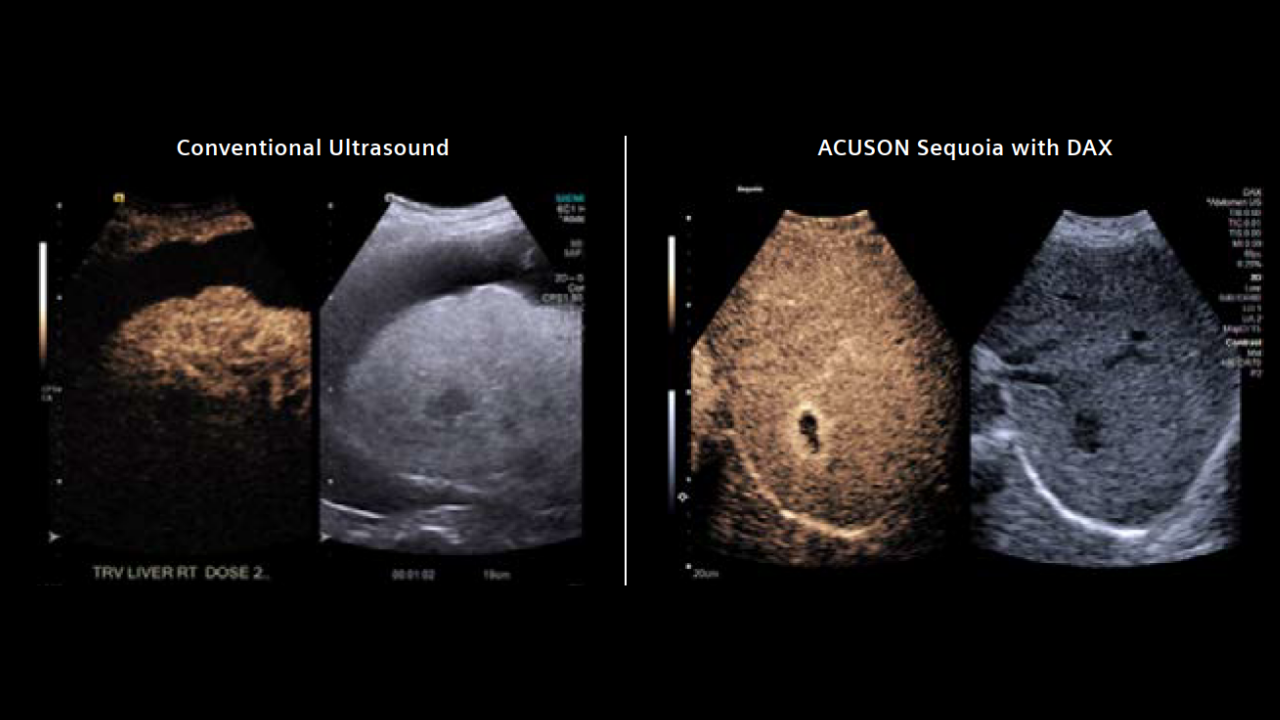 DAX transducer provides Confident Hemangioma diagnosis