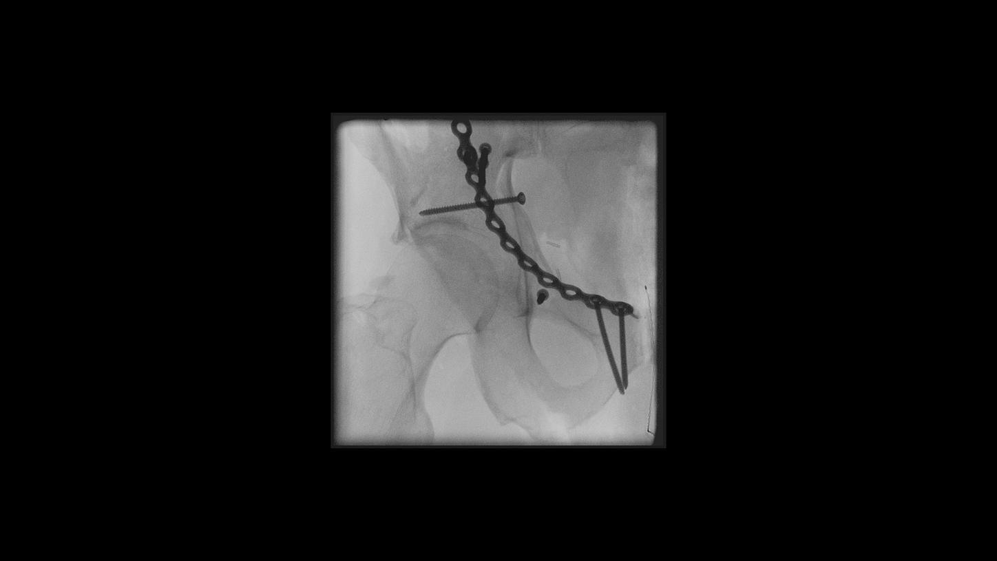 Pelvis surgery with Cios Select, a 2D C-arm for surgery.