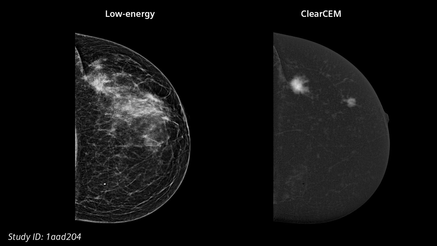 ClearCEM - Fast identification of potential cancers