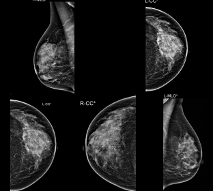 Diagnostic Mammography