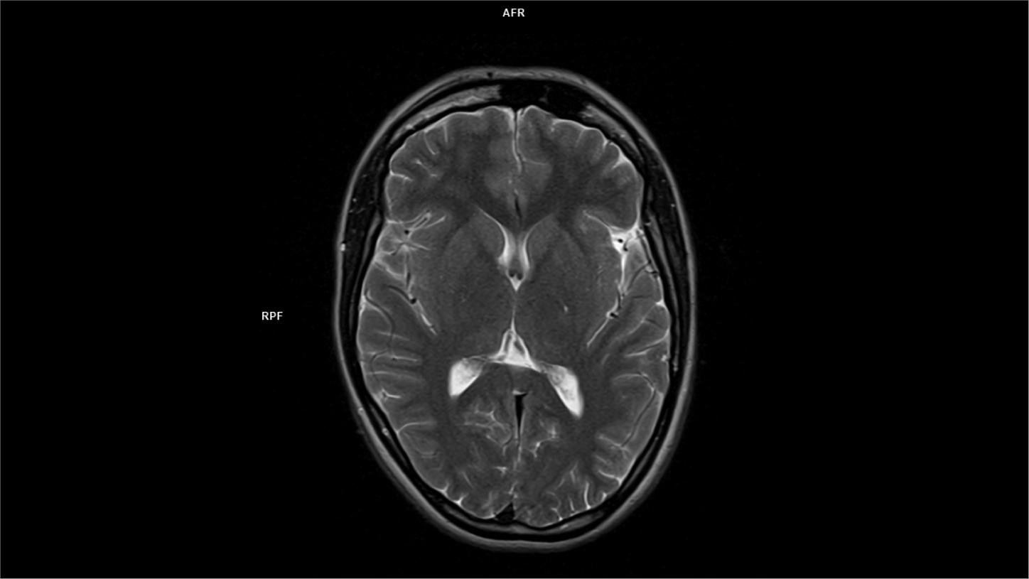 Axial T2-MAGNETOM Free.Max/Coil-HN12/Resolution-640/Scan Time-2:50/Aceleration-p2 DRS