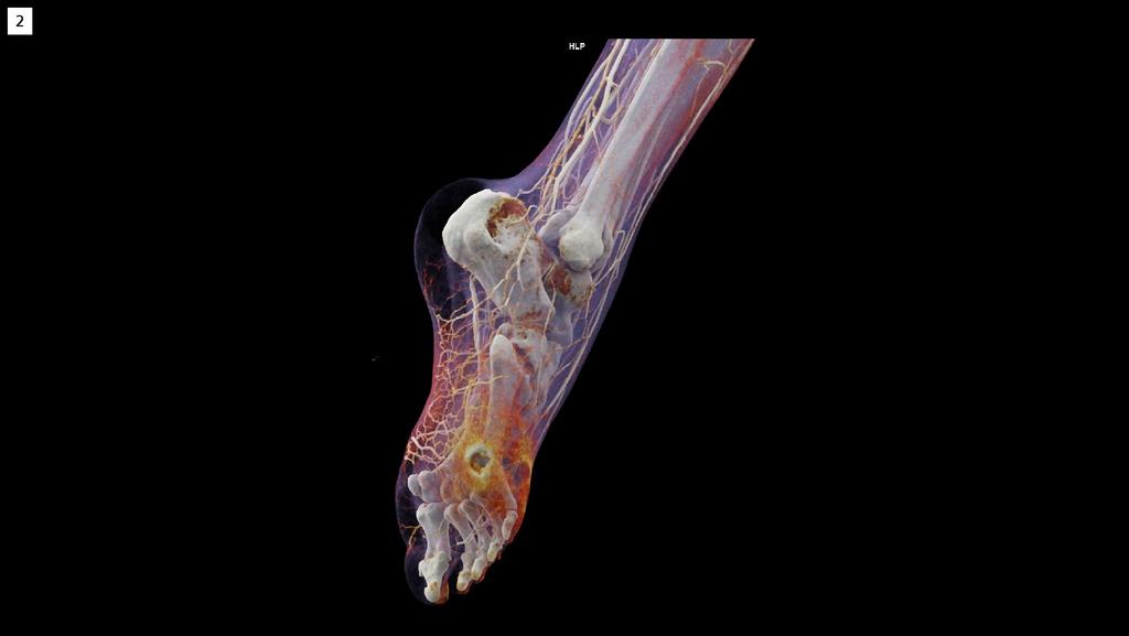 Diabetic Foot Syndrome - Siemens Healthineers USA