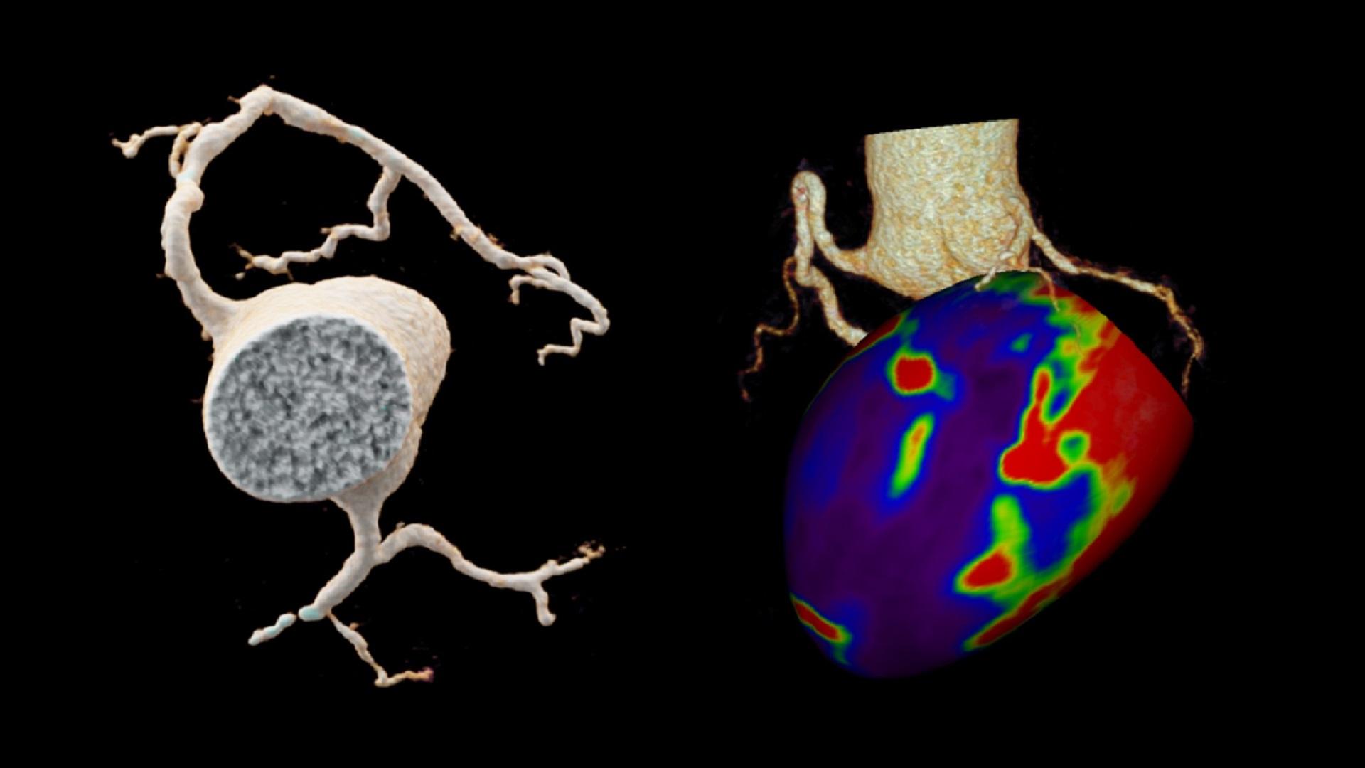 LAD Occlusion – Acute or Chronic? - Siemens Healthineers USA