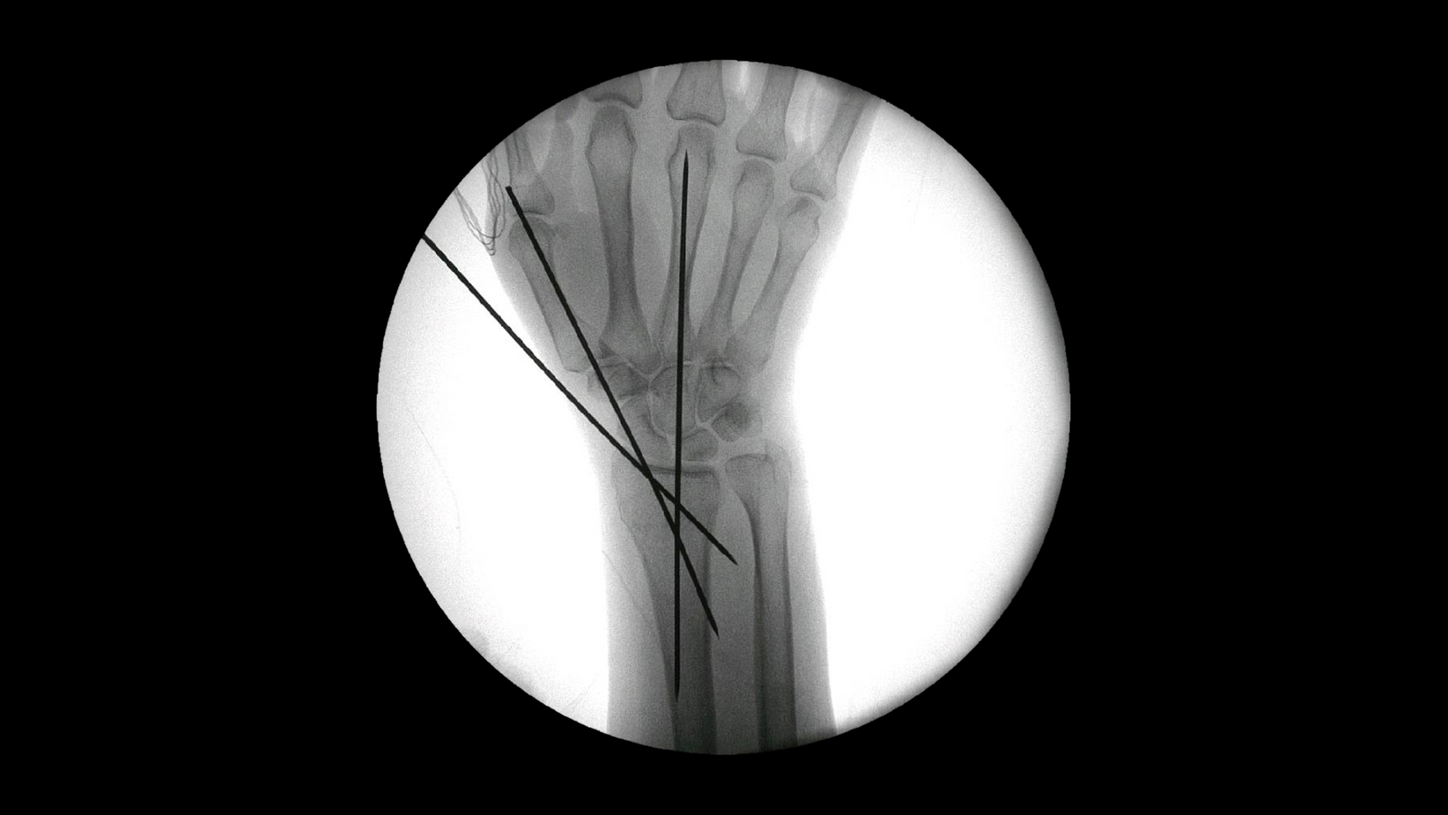 Hand and wrist surgery with Cios Fit, a mobile 2D C-arm for surgery.