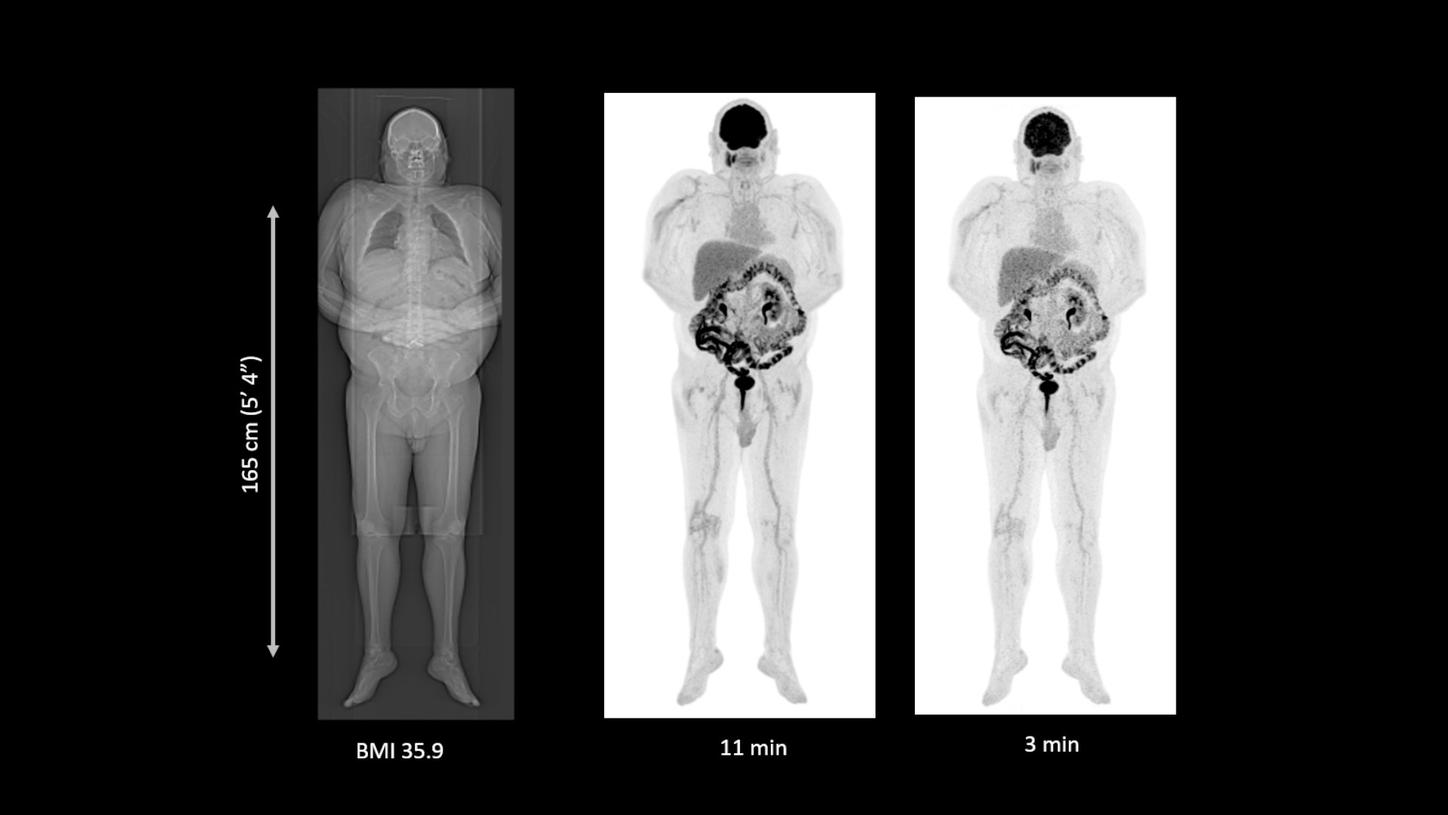 Whole-body scan for the assessment of melanoma treatment response