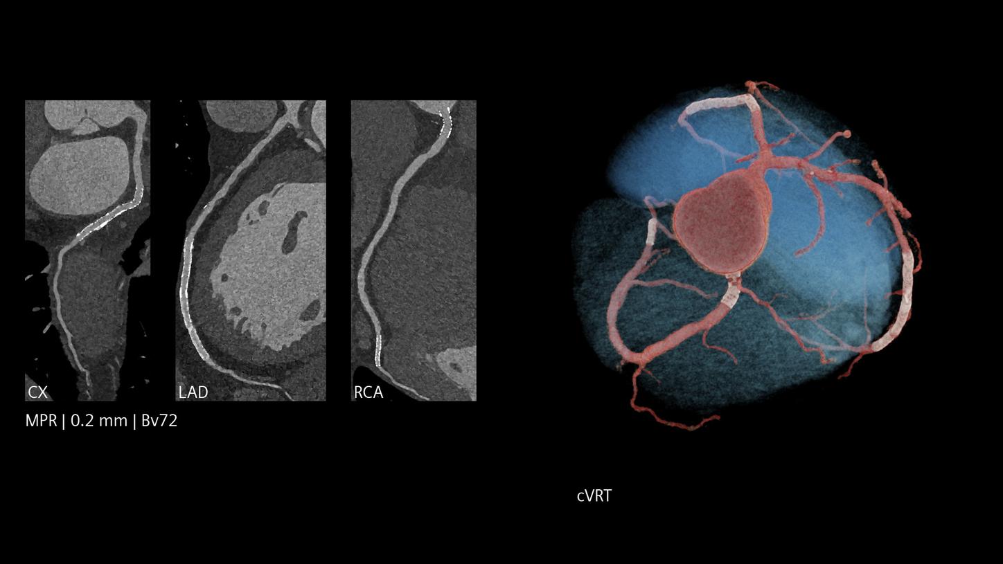 Cardiac CT with stents in coronary arteries and a 3D reconstruction showing vessel pathways and heart structure.
