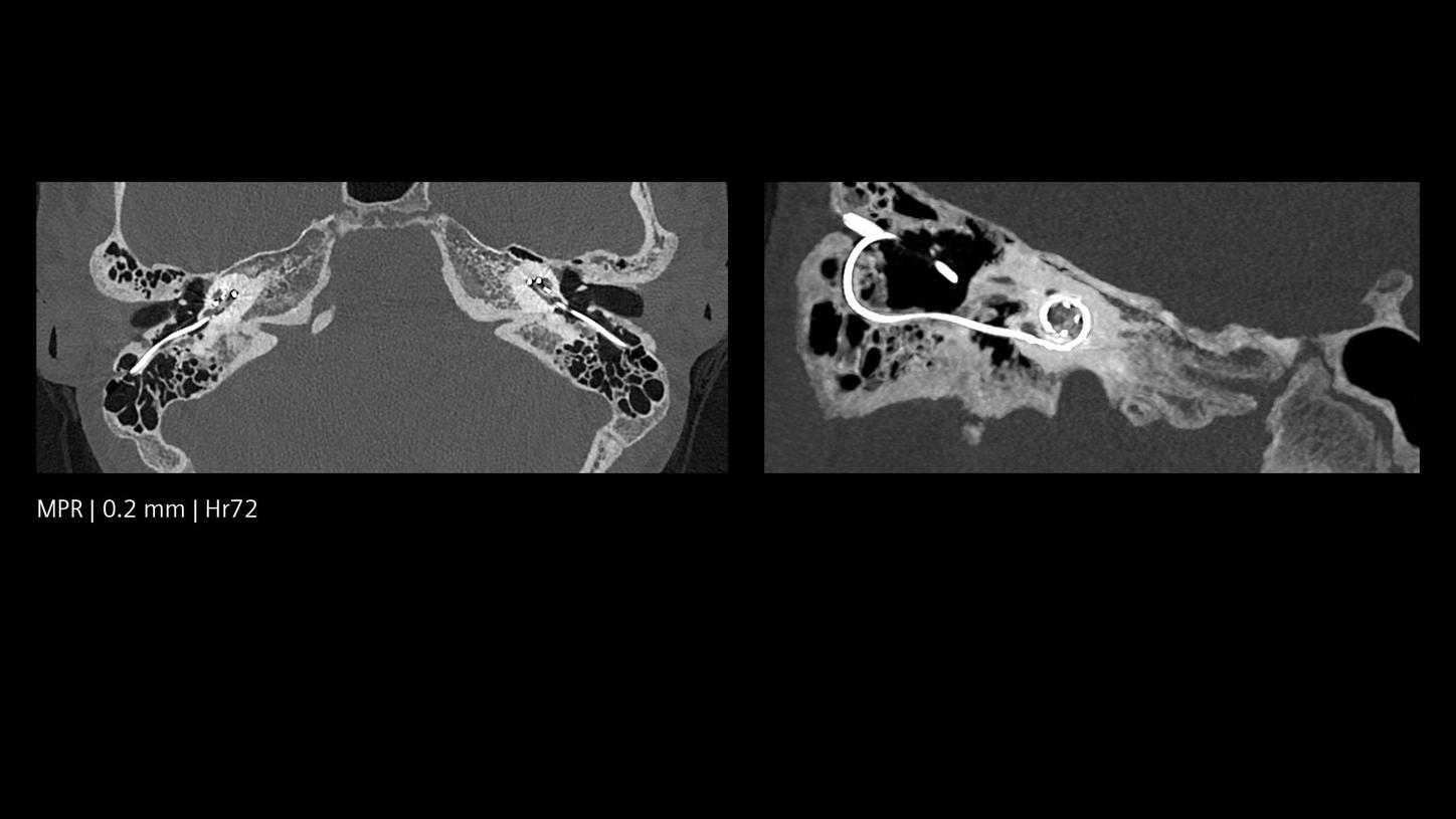 Pediatric CT cochlear implant imaging with excellent spatial resolution acquired by a NAEOTOM Alpha photon-counting CT.