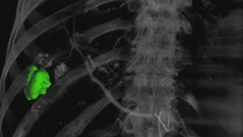 Semi-automatic 3D liver lesion contouring shows the tumor’s true morphology