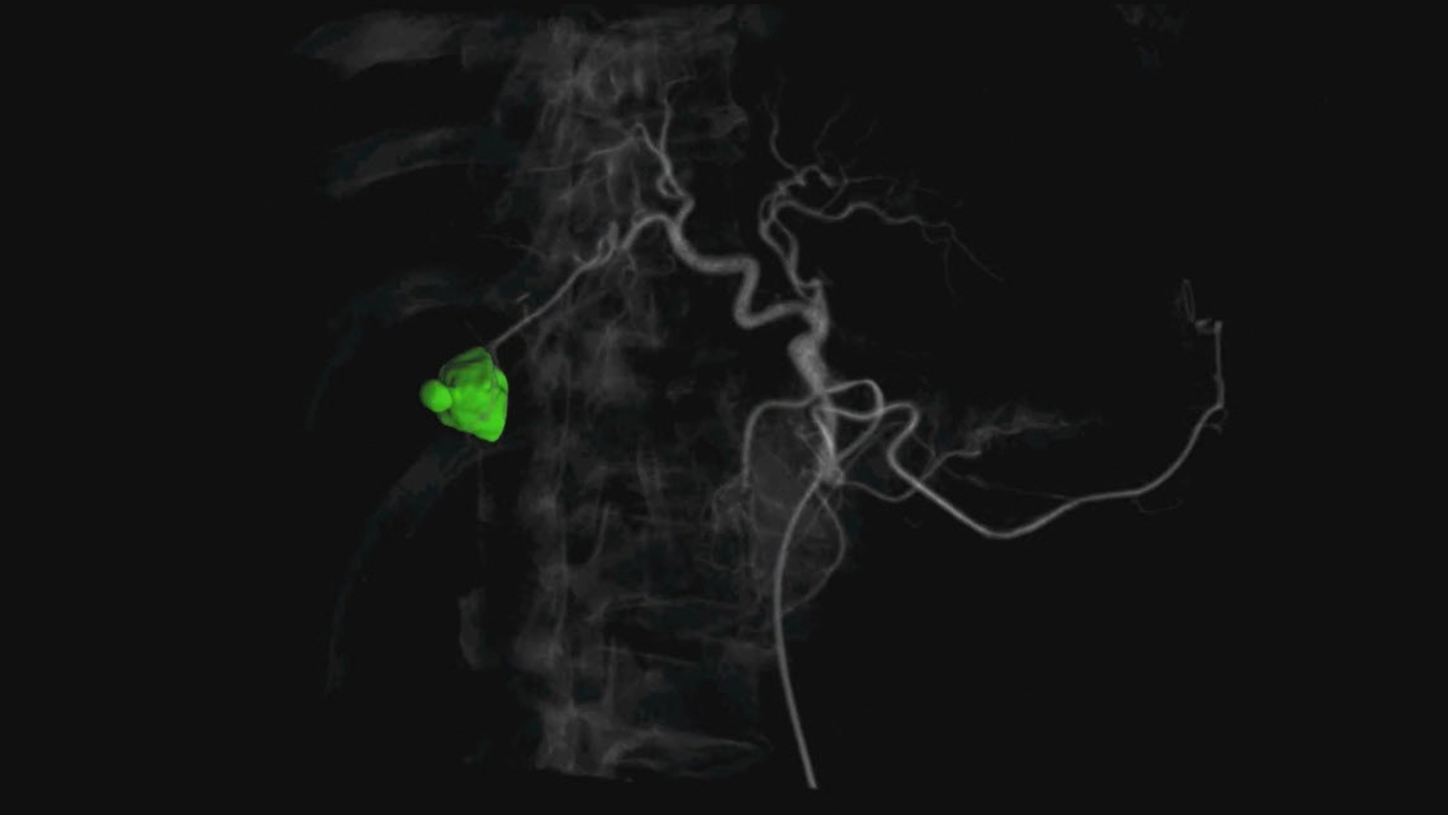 Semi-automatic 3D liver lesion contouring shows the tumor’s true morphology