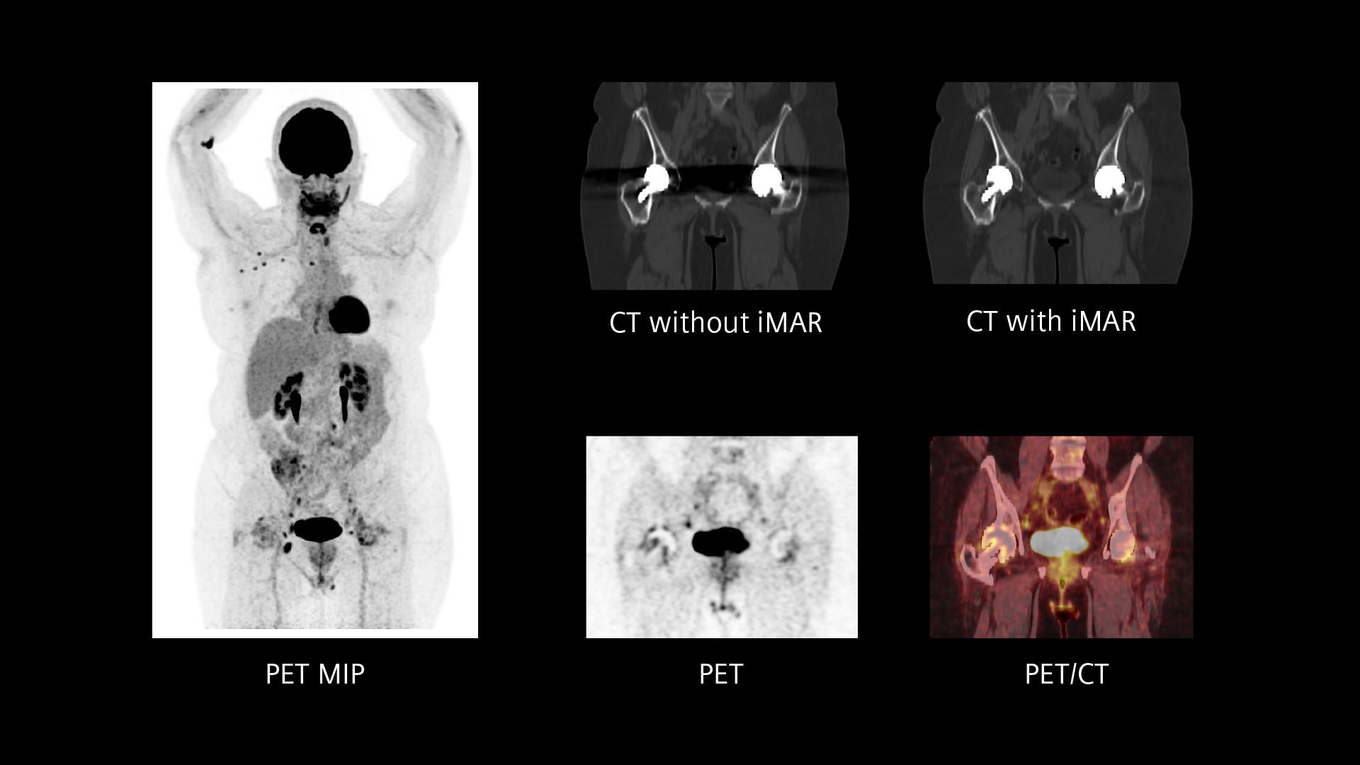 Biograph Trinion PET/CT scanner - Siemens Healthineers
