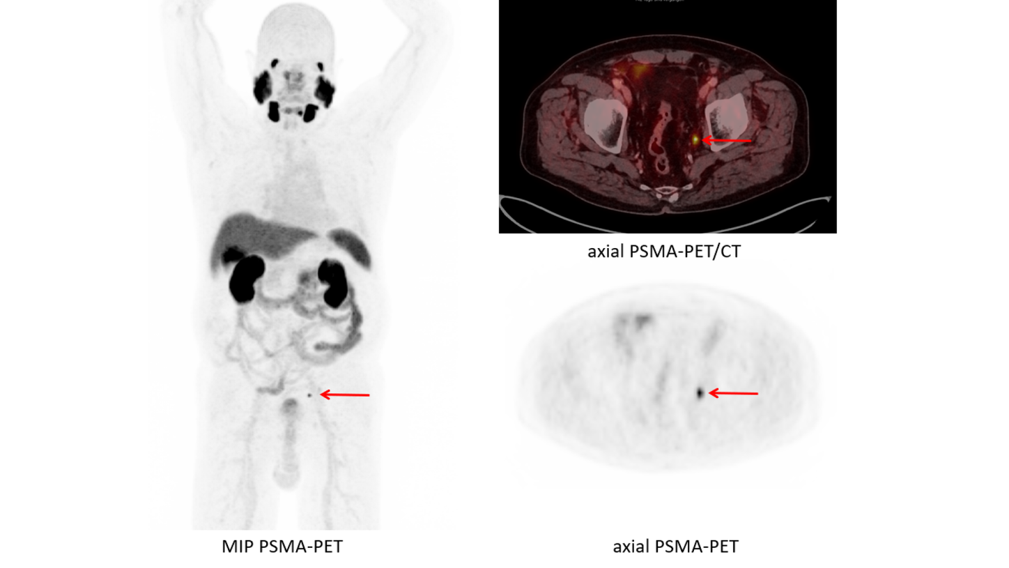 PSMA PET/CT presenting a focal PSMA uptake in a lymph node parailical left, indicating a lymph node metastasis (arrow).