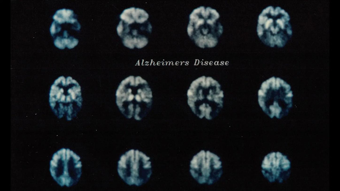 Grid of brain scan images illustrating changes associated with Alzheimer’s disease, with the label “Alzheimers Disease” centered.