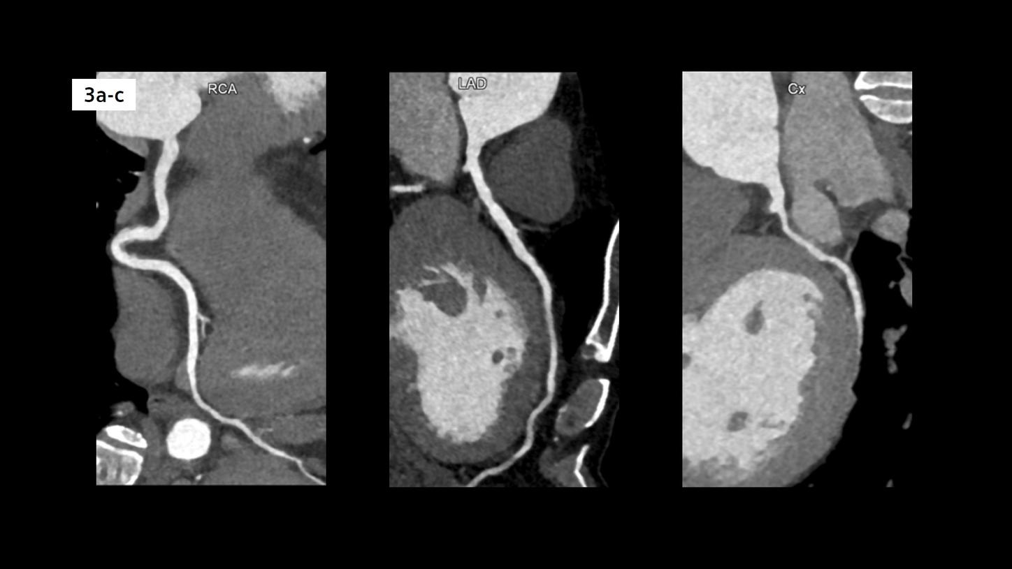 Curved MPR images show three normal coronary arteries.