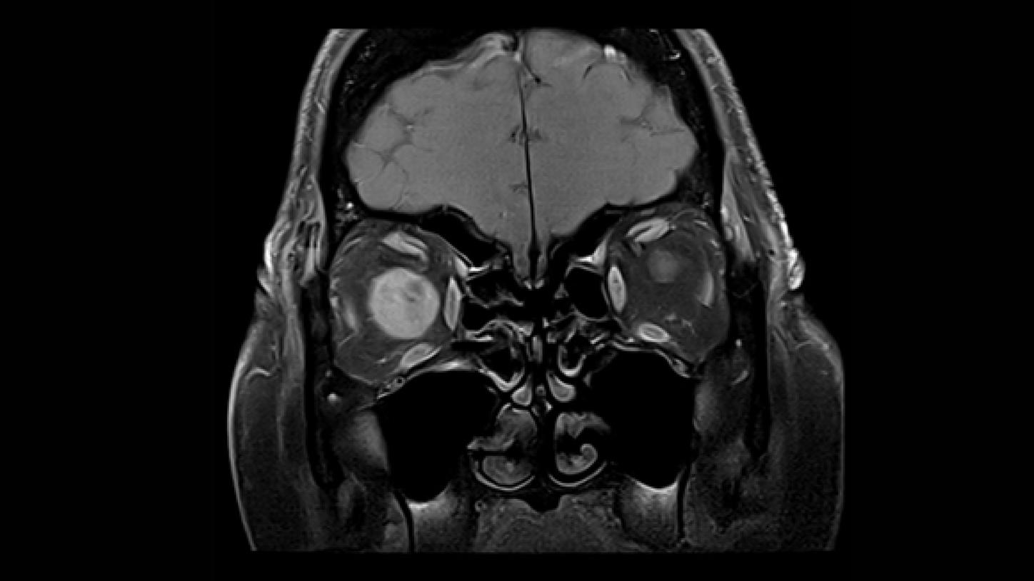 meningioma óptico