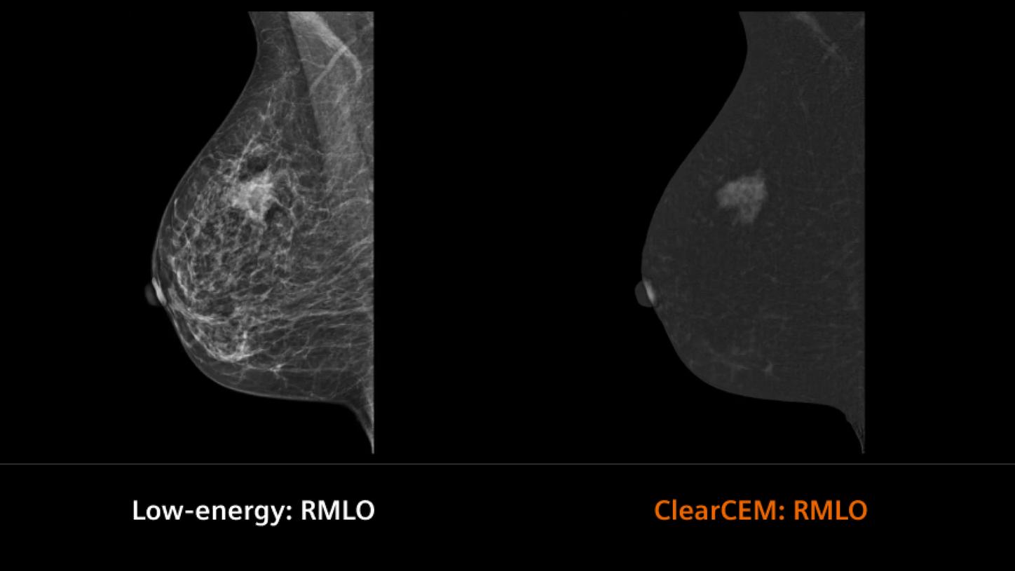 Clinical image breast