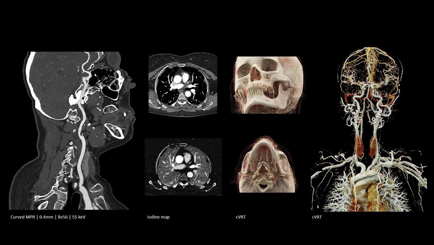 CTA of the head/neck 