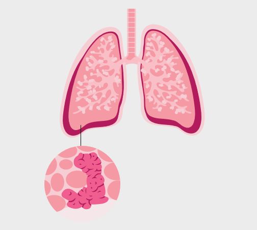 Large cell lung carcinoma