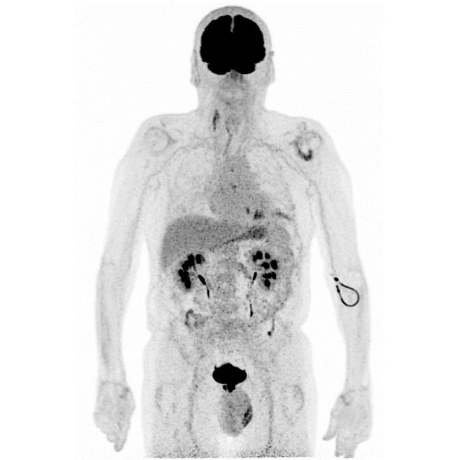 Oncology Indications FDG Prostate