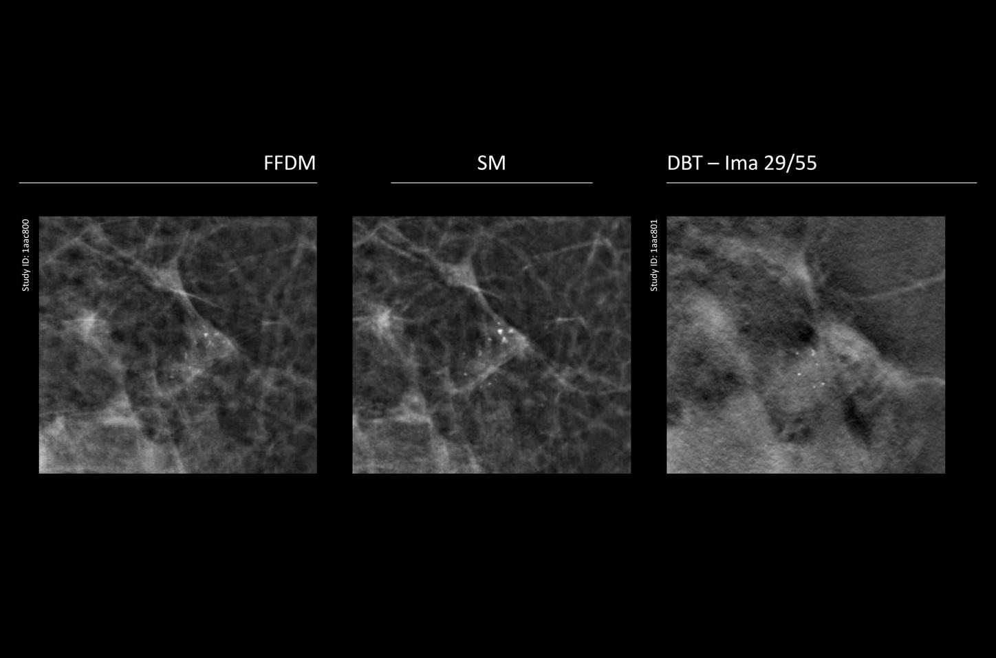 CT image of retro-ocular masses causing exophthalmos along with bilateral perinephric, pericardial, and pelvic exudates