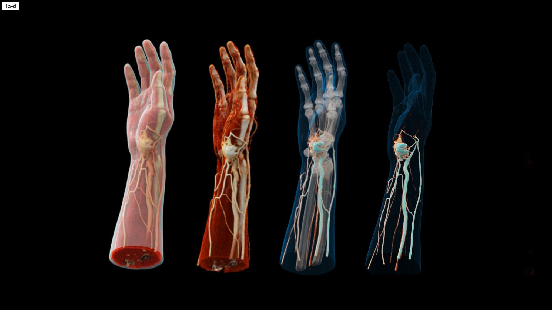Subcutaneous arteriovenous malformation on the right wrist - Siemens ...