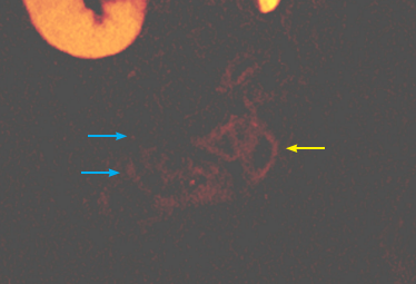 iodine mapping image