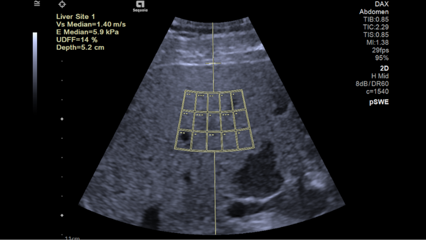 Ultraschallbild Auto pSWE der Leber