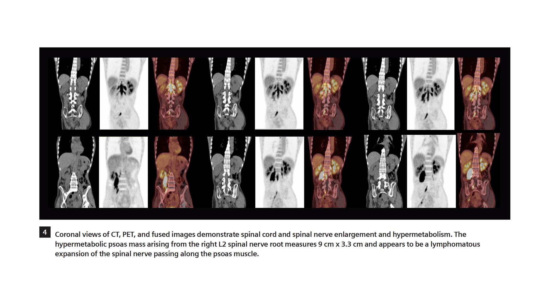 18F FDG PET/CT Delineation of Diffuse Large B-cell Lymphoma - Siemens ...
