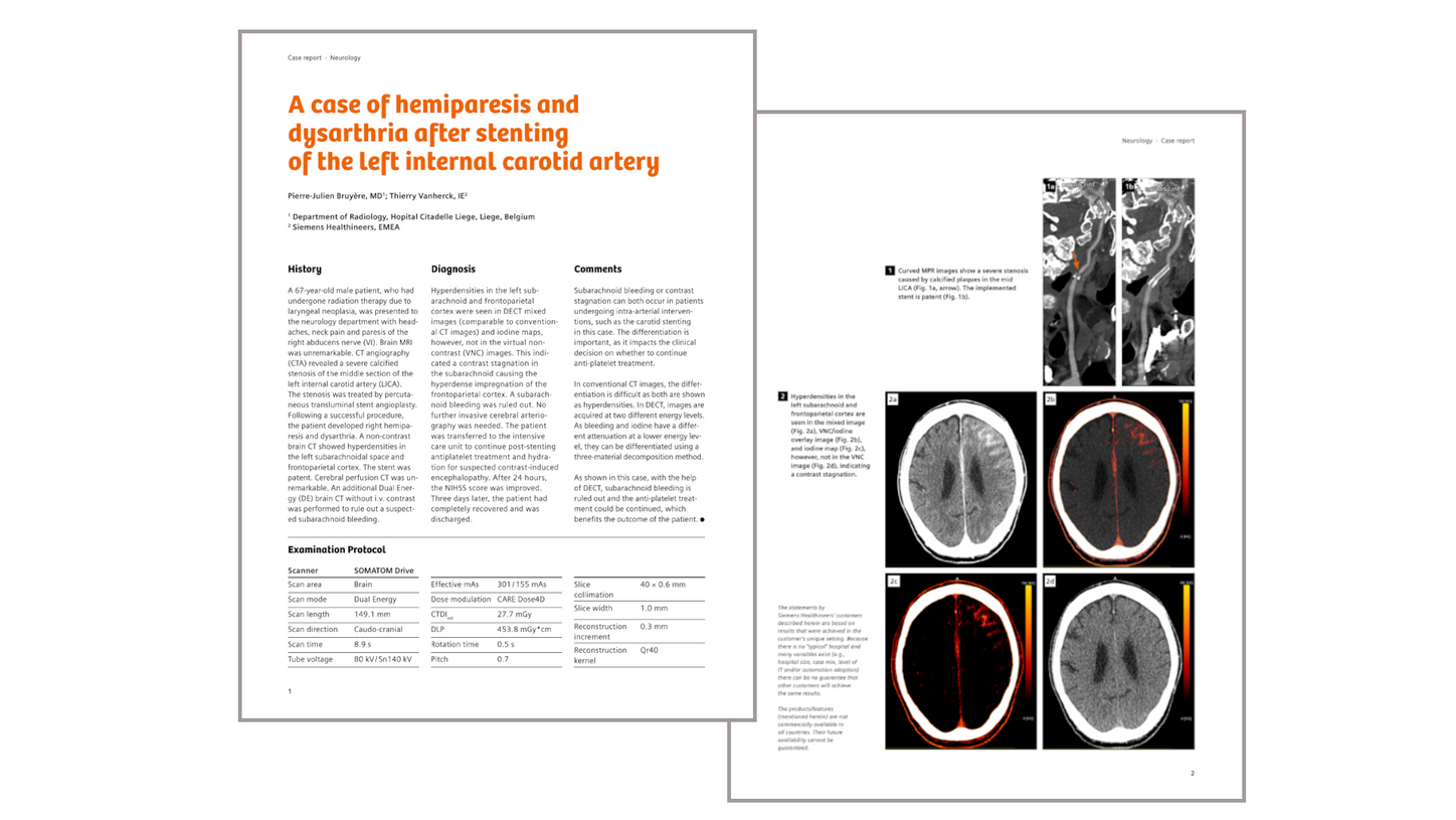 Clinical case preview: Differentiation between subarachnoid bleeding and contrast stagnation after carotid stenting