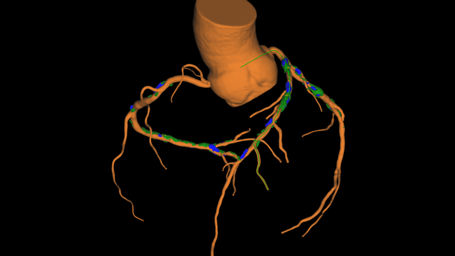 CT GUIDED PCI