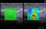 Image F: Elastography image demonstrating heterogeneous red elasticity, indicating higher velocities within the mass compared to the surrounding breast tissue. This finding suggests marked stiffness of the mass.