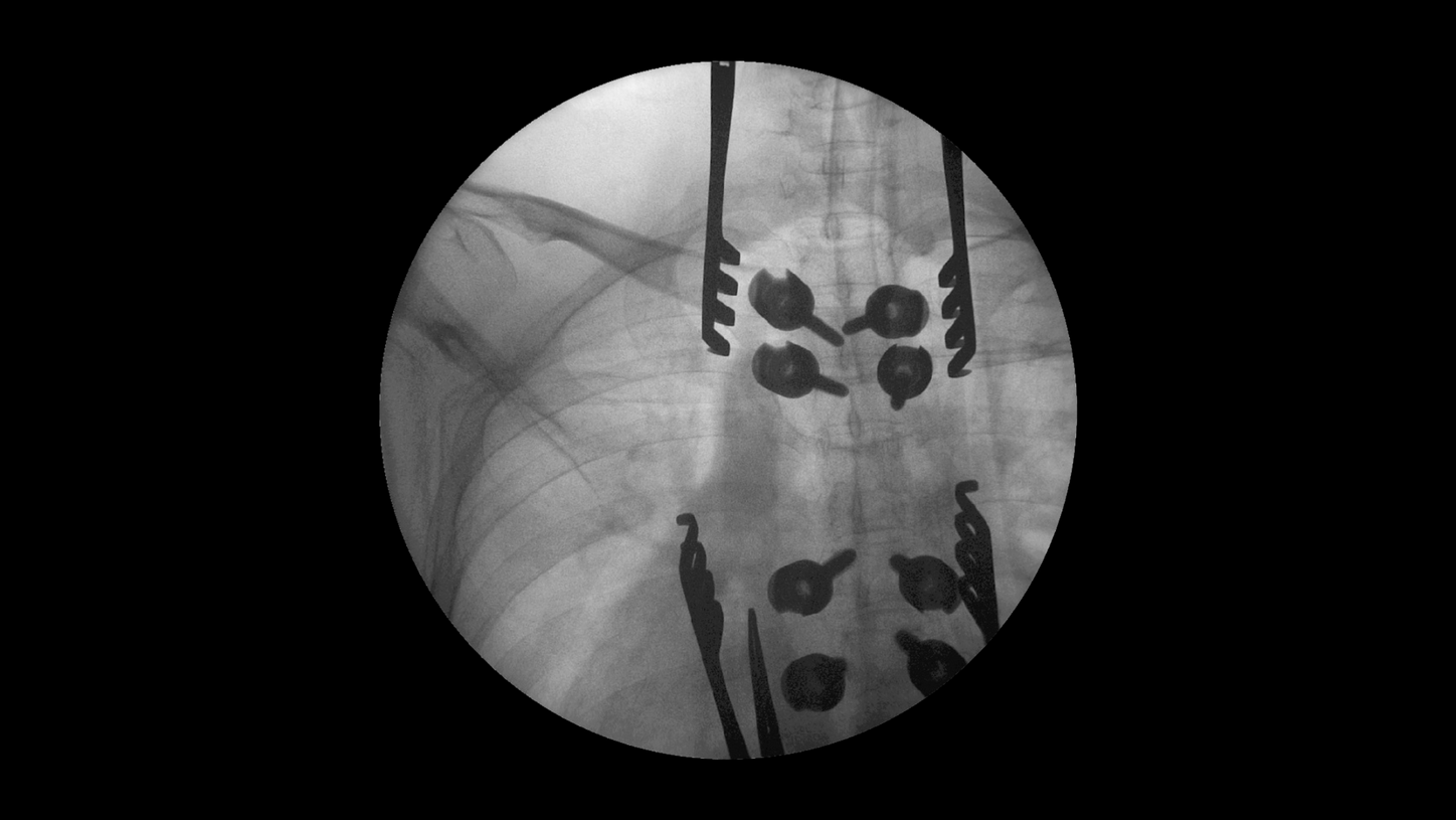 Spine surgery with Cios Fit, a mobile 2D C-arm for surgery.