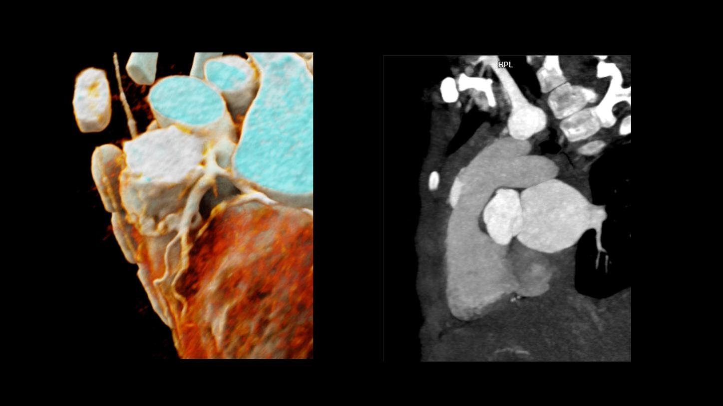 A cVRT image and a MPR image show a single, small coronary fistula originating off the proximal LAD, coursing posteriorly and draining into the left anterior wall of the MPA, just distal to the pulmonary valve.