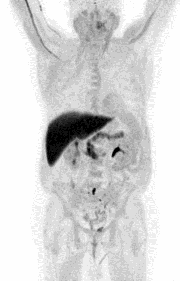 Axumin prostate