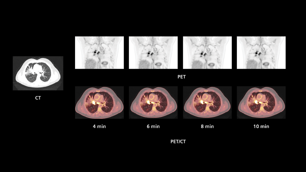 Biograph Vision clinical case