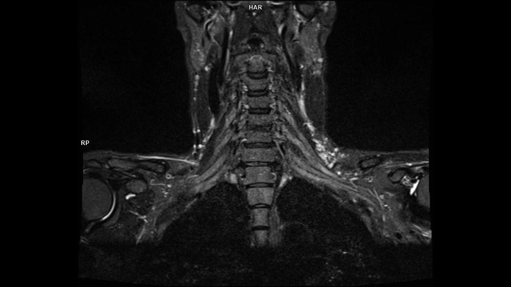 T2 SPACE STIR COR-MAGNETOM Sola/Coil-HeadNeck 20/Resolution-320/Scan Time-4:19/Aceleration-p3