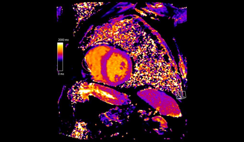 CT image of retro-ocular masses causing exophthalmos along with bilateral perinephric, pericardial, and pelvic exudates