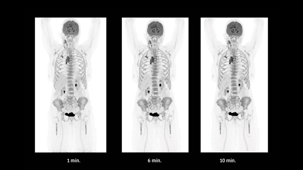 A Quantum Leap In PET/CT Imaging - Siemens Healthineers