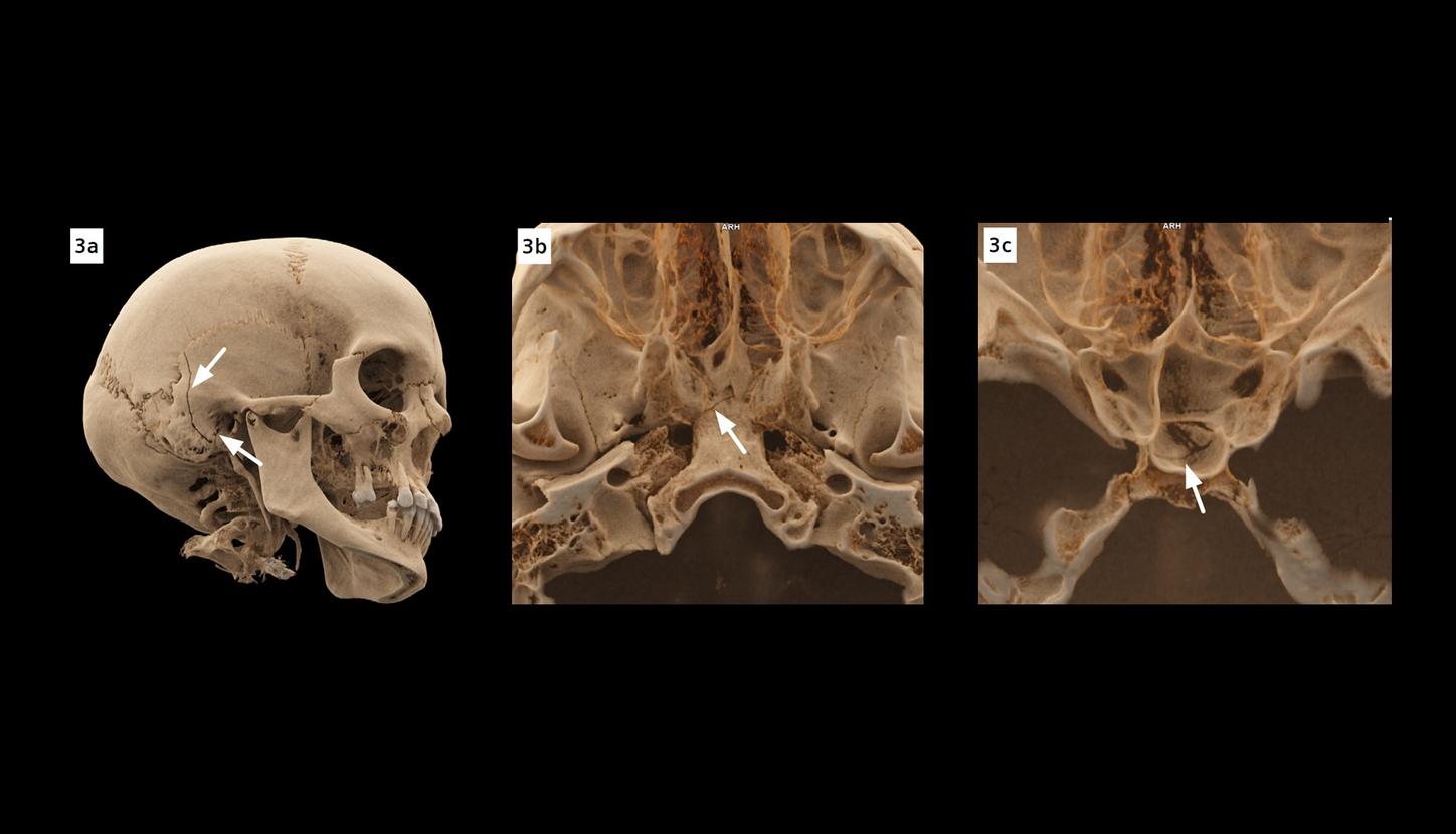 cVRT images show longitudinal fractures of the right temporal bone, involving the mastoid cells and the external auditory canal, as well as a complex fracture of the body of the sphenoid bone.