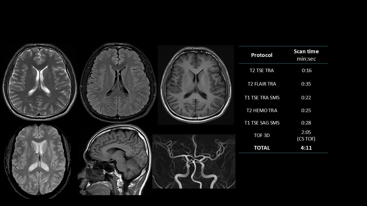 siemens-healthineers_magnetomworld_Brain-MRA-rountine