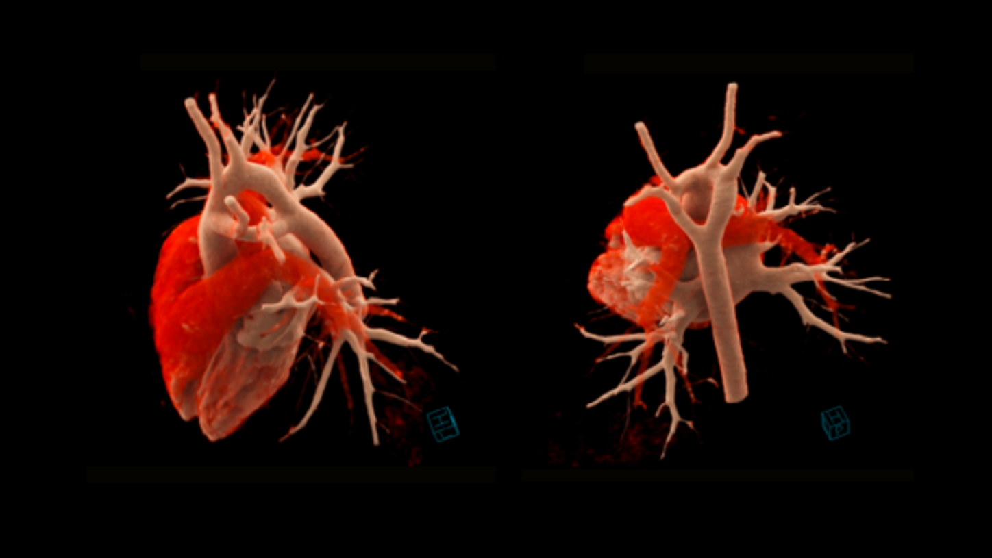Double aortic arch acse study key image