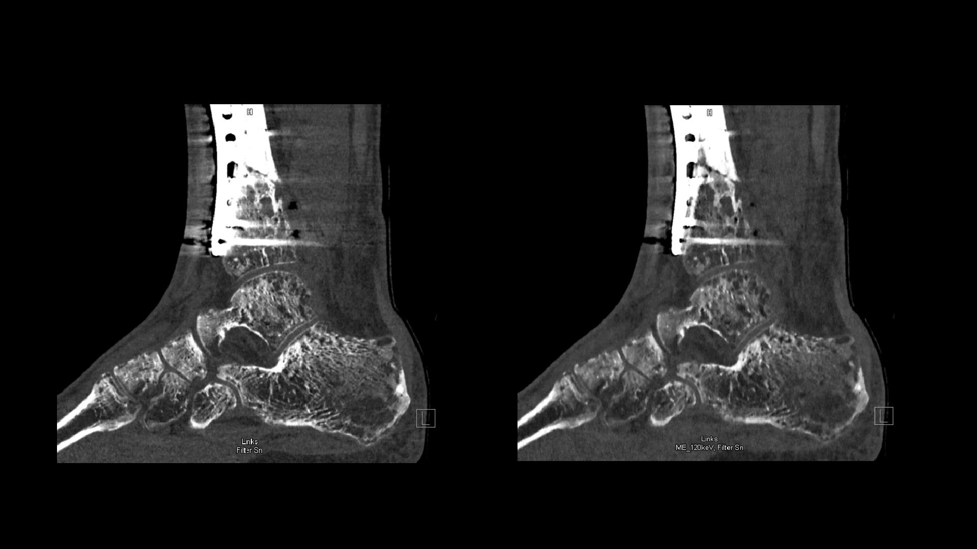 Tibia Press Pseudarthrosis revision of a comminuted tibia fracture – consolidated ...