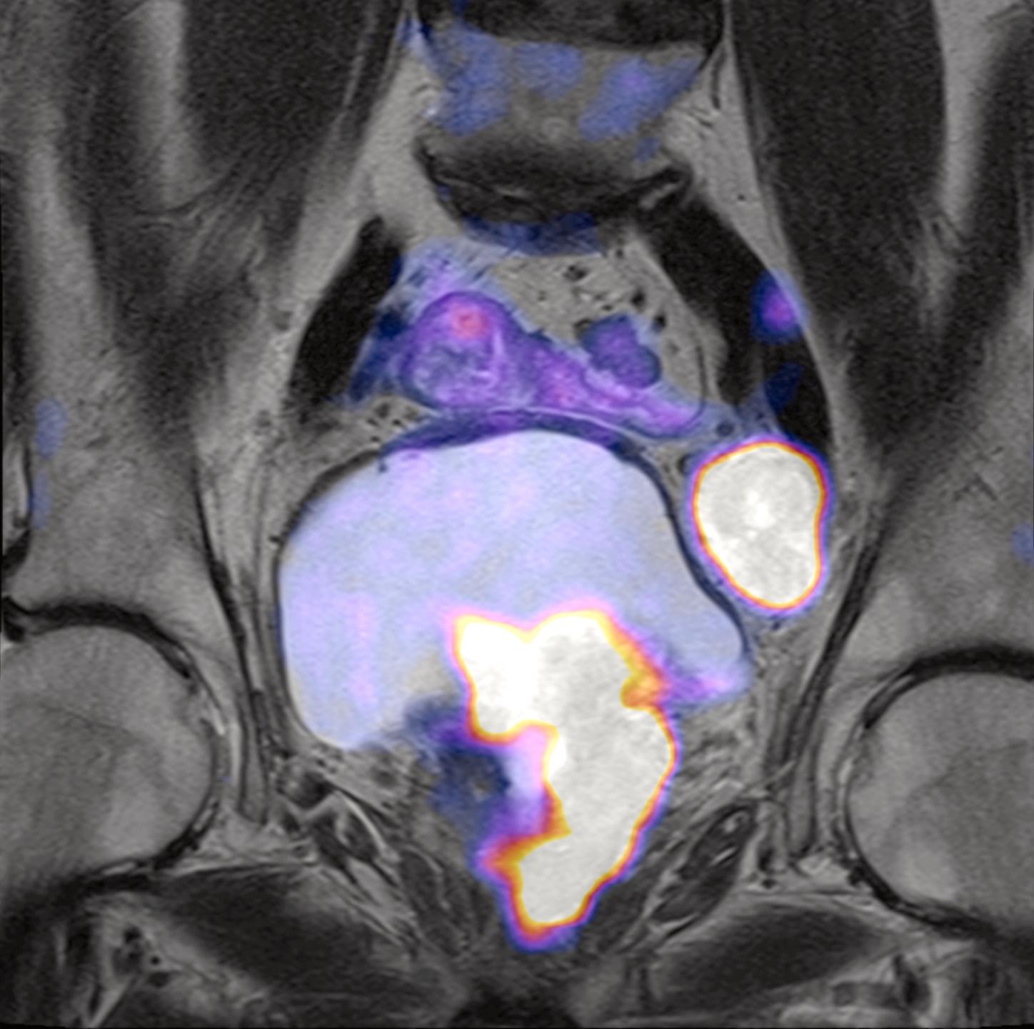 ganglio-pelvico-fusion-ct-scanner