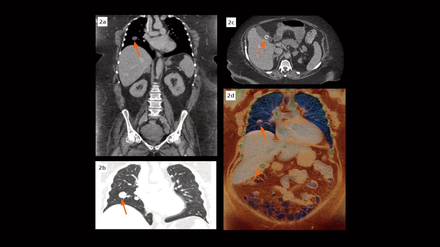 Coronal MPR images (0.5 mm) show a small, well-defined round lesion, without enhancement, in the right middle lobe. A centimeter-sized round gallstone with a hyperdense ring is seen in an axial image. A cVRT image reconstructed with 0.5 mm slices show both the lung lesion and the gallstone in three dimensions.