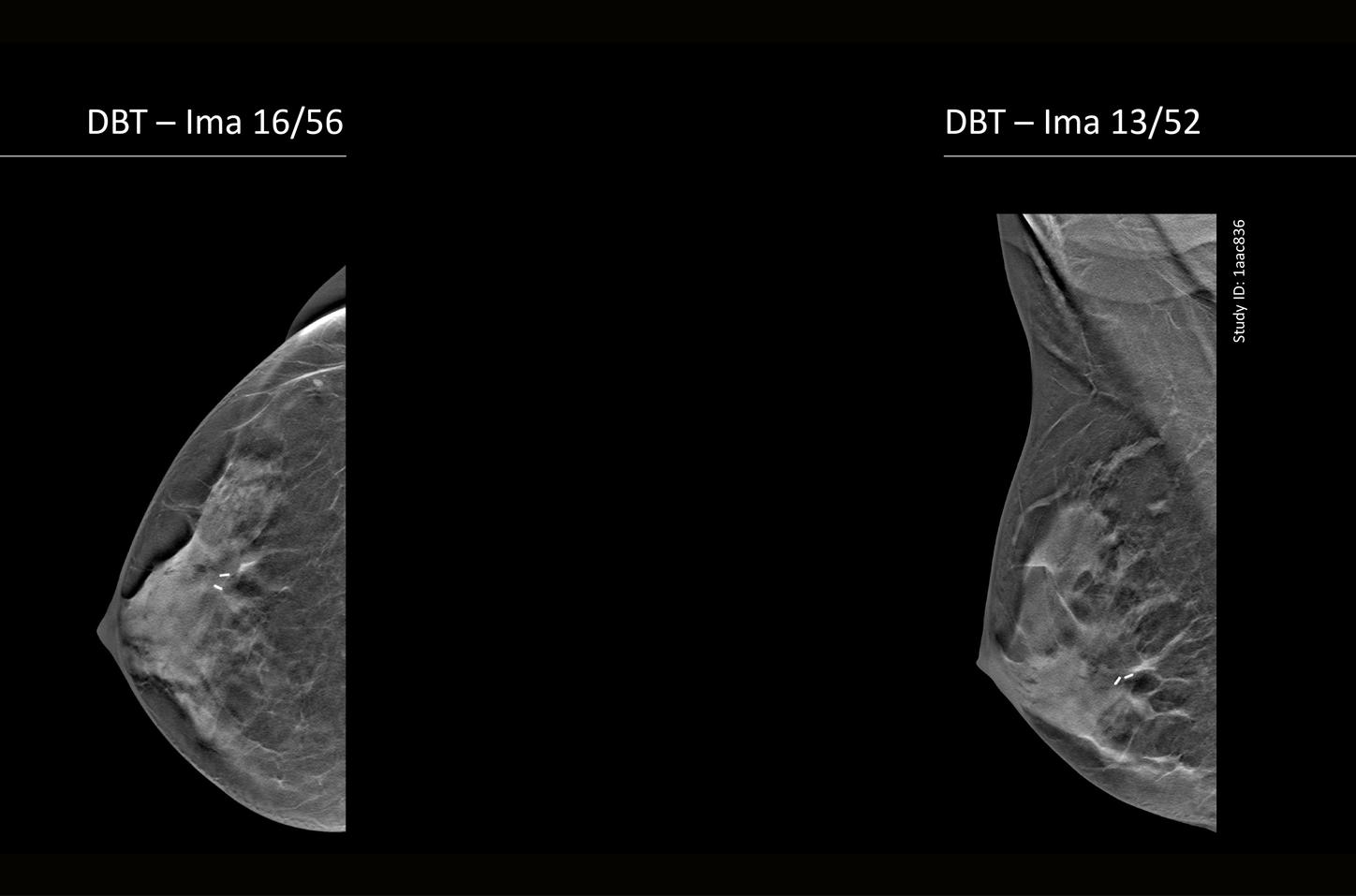 Microcalcificaciones pleomórficas en mama izquierda: diagnóstico de carcinoma ductal in situ grado 2