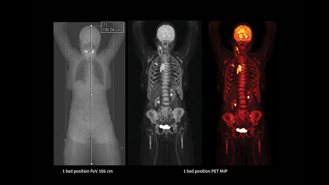 Whole-body molecular images (from top of head to middle of the thighs) acquired on Biograph Vision Quadra.