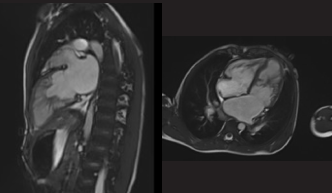 Fig. 2: CMR CINE images: (A) 2-chamber view showing a centrally located papillary muscle with radially coursing accessory muscular bands extending to all LV walls. (B) 4-chamber view demonstrating the anomalous papillary muscle causing mid-cavitary obstruction.