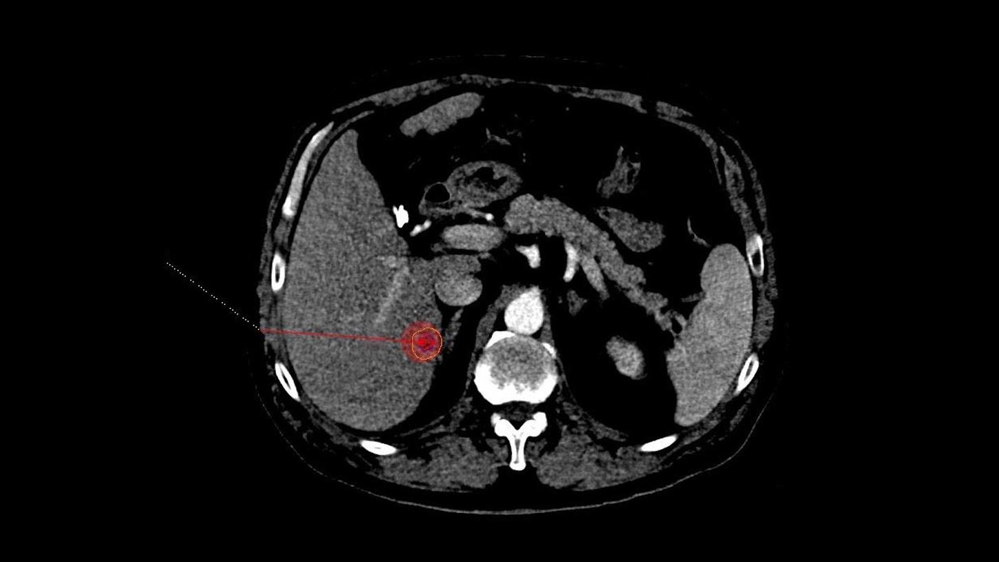 Probe Planning myAblation Guide liver ablation